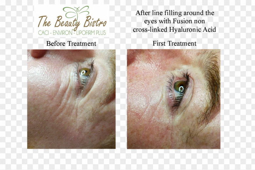 Eyelash Extensions Wrinkle Cosmetics Cheek Mesotherapy PNG