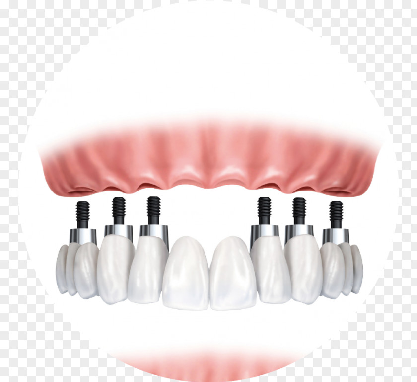 Bridge Dental Implant Dentistry Dentures PNG