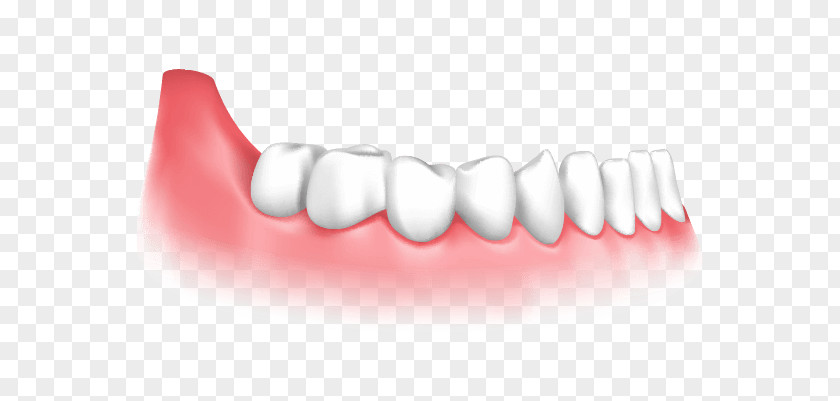 Crown Dental Implant Dentistry Gingival Graft PNG