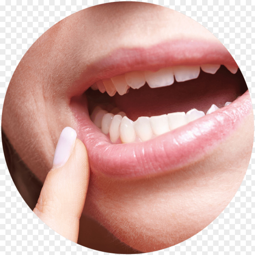 Chewing Gum Aphthous Stomatitis Dentistry Mouth Ulcer Gums PNG
