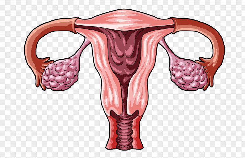 Woman Ovarian Cyst Ovary Apoplexy Corpus Luteum PNG