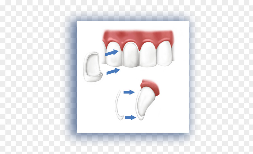 Fill A Tooth Veneer Cosmetic Dentistry Crown PNG