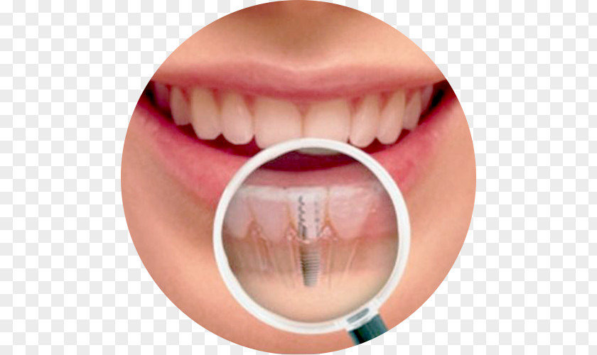 Health Dental Implant Human Tooth Dentistry PNG
