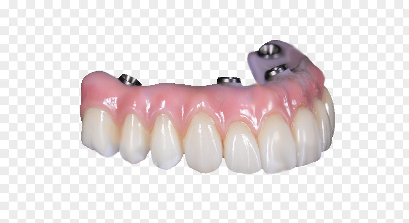 Bridge Tooth All-on-4 Dentures Dental Implant PNG