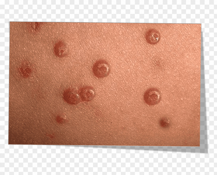 Child Molluscum Contagiosum Skin Wheal Pediatrics Infectious Disease PNG