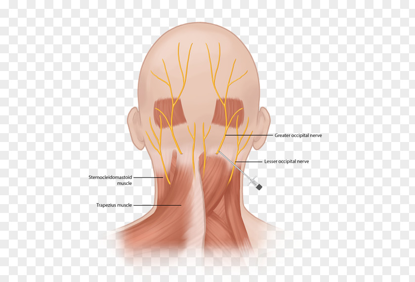 Stellate Occipital Neuralgia Greater Nerve Artery Chronic Pain Management PNG