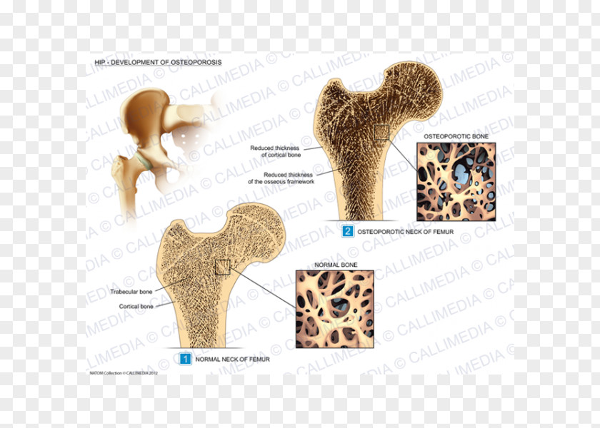 Osteoporosis Hip Rheumatology Osteoarthritis Illustration Anatomique PNG