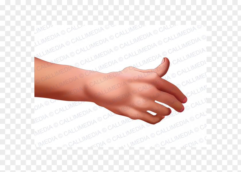 Hand Thumb Rheumatoid Arthritis La Artritis Rheumatism PNG