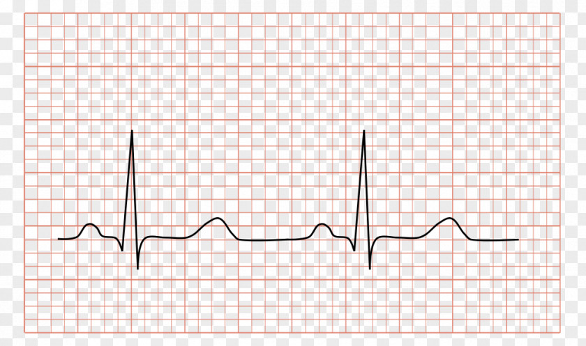 Electrocardiogram Electrocardiography QRS Complex Medicine Cardiology Heart PNG