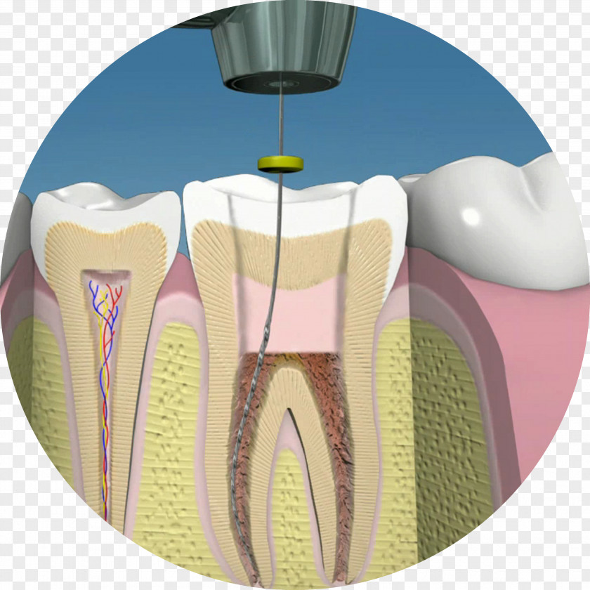 Endodoncia Endodontic Therapy Dentistry Human Tooth Pulp PNG