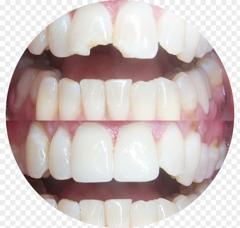 Crown Tooth Dentistry Veneer PNG