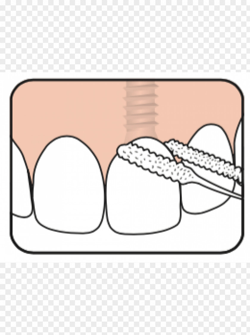 Dental Floss Nit Tooth Implant Jaw PNG