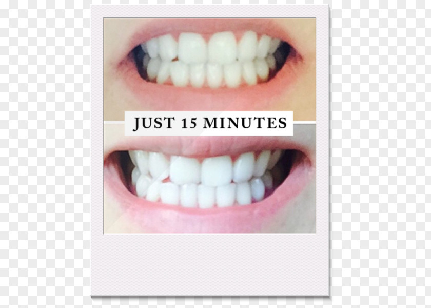 Before And After Tooth Whitening Human Laser PNG