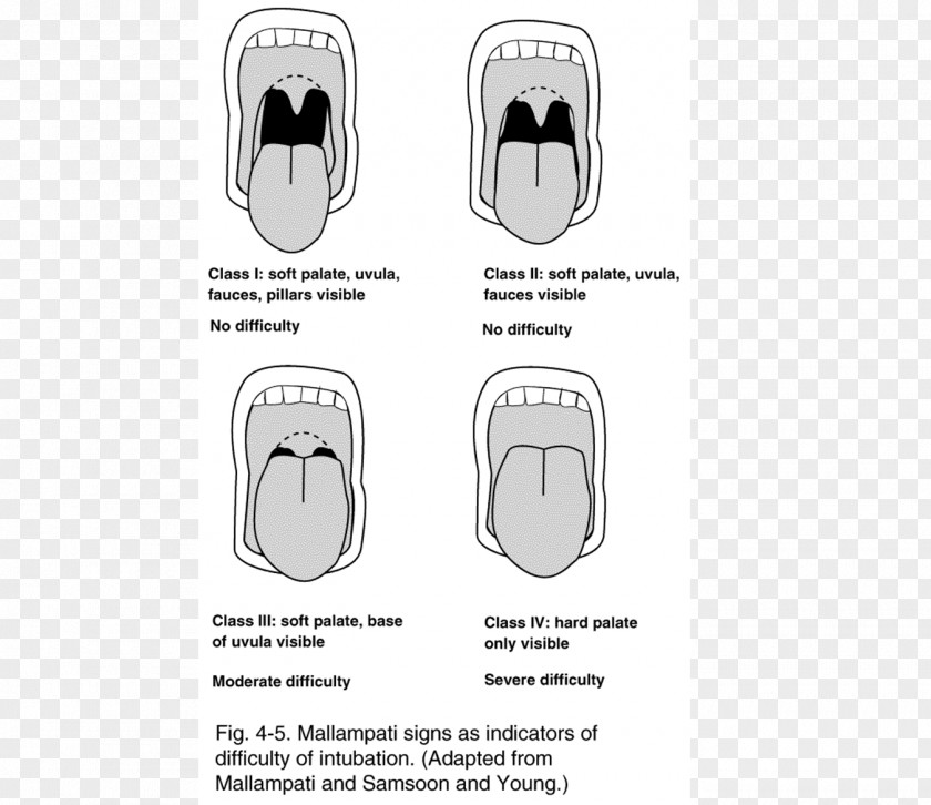 Airway Management Respiratory Tract Mallampati Score Tracheal Tube Anatomy PNG