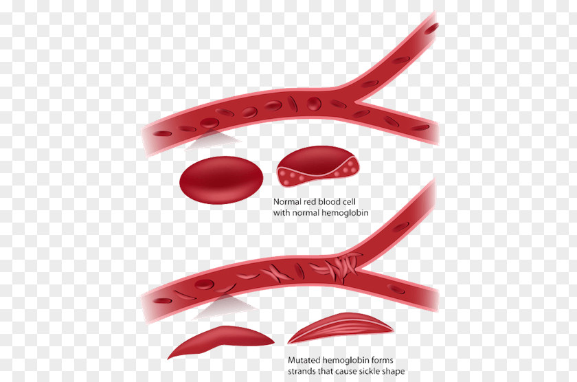 Sickle Cell Disease Red Blood Anemia PNG