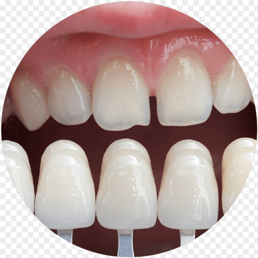 Bridge Veneer Cosmetic Dentistry PNG