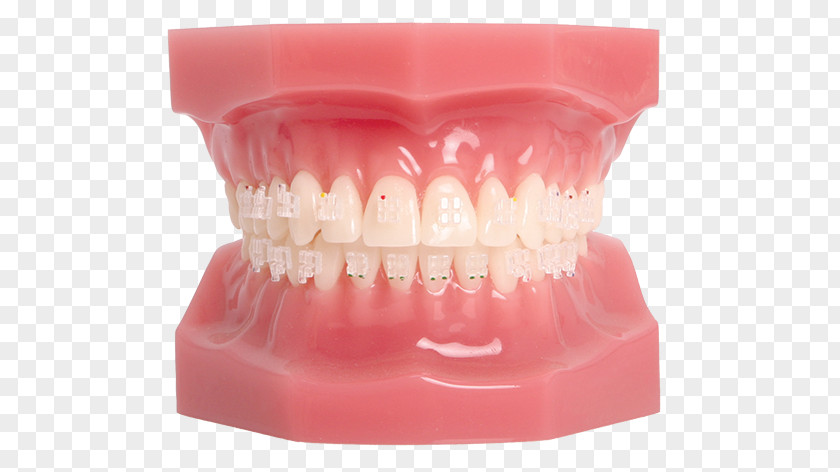 Tooth Dental Braces Orthodontics Splint Maxilla PNG
