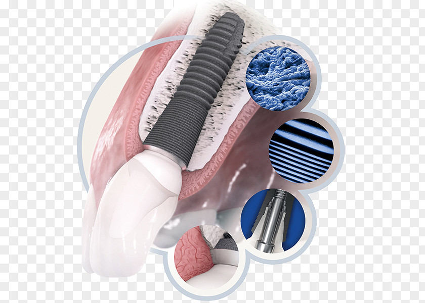Microdermal Implants Dental Implant Dentistry Tooth PNG