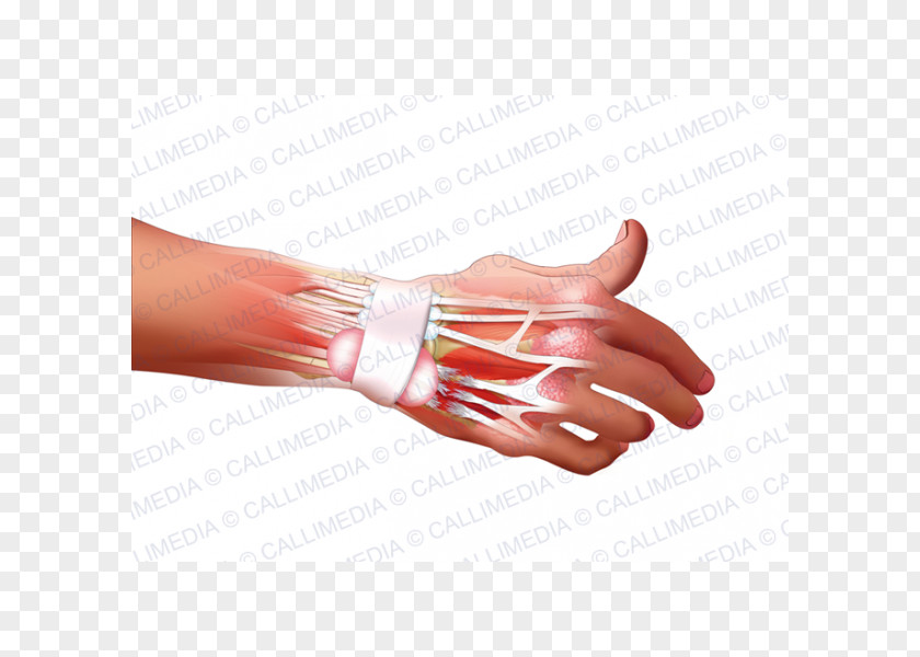 Hand Model Nail Rheumatoid Arthritis Disease PNG