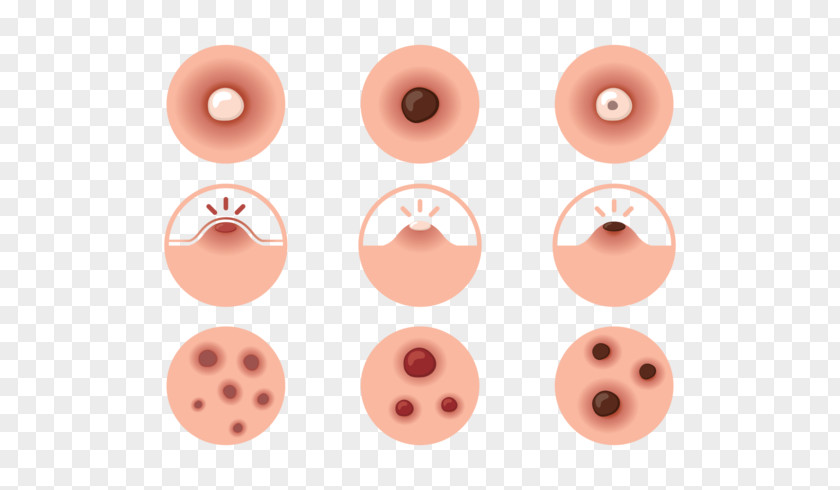 Pimple Propionibacterium Acnes Anxiety Nose Cheek PNG