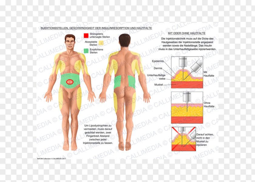 Subcutaneous Injection Insulin Disease Muscle PNG