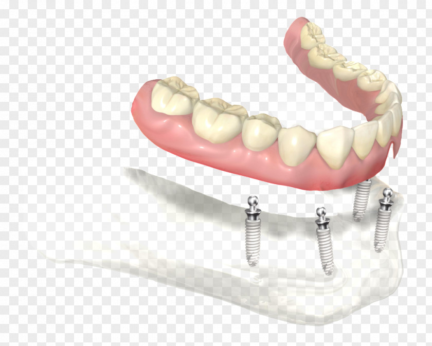 Dentures Dental Implant Dentistry Prosthesis Abutment PNG