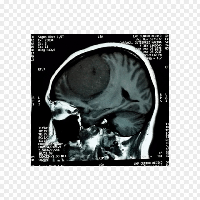 Skull Computed Tomography Brain Tumor Agy Cancer PNG