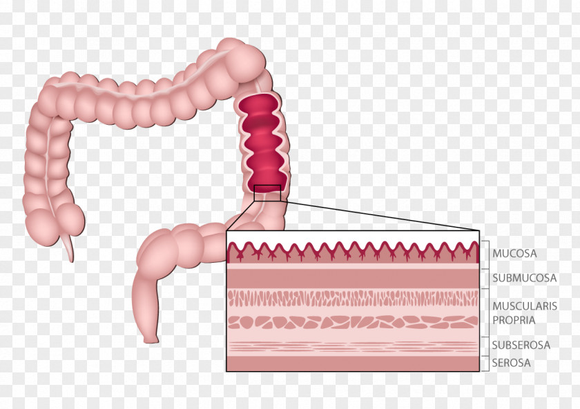 Anatomy Hereditary Nonpolyposis Colorectal Cancer Large Intestine Surgery PNG