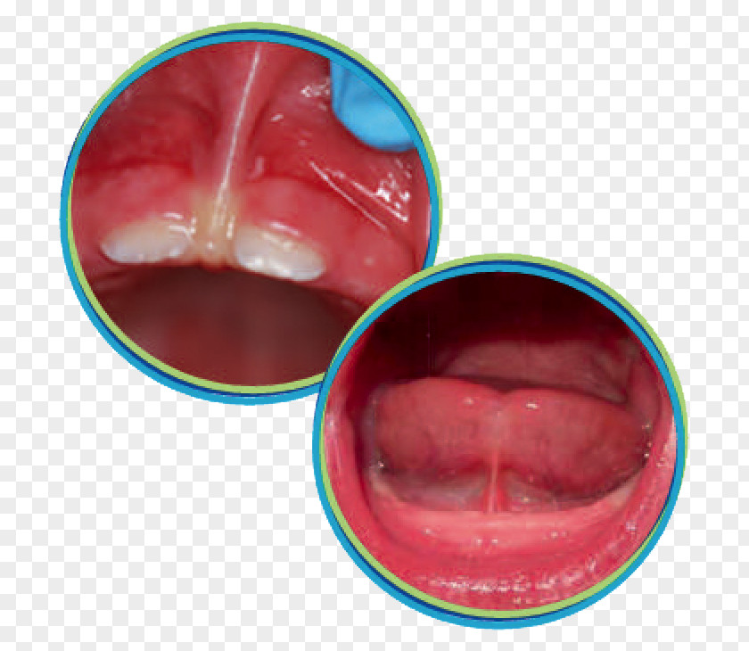 Tongue Ankyloglossia Lip Frenectomy Mouth PNG