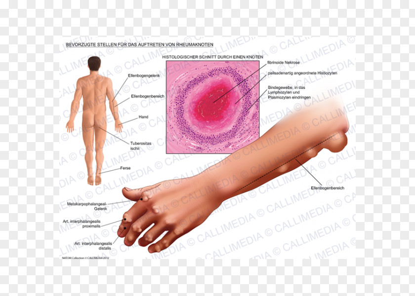 3d Men Rheumatoid Nodule Arthritis Rheumatism Disease PNG