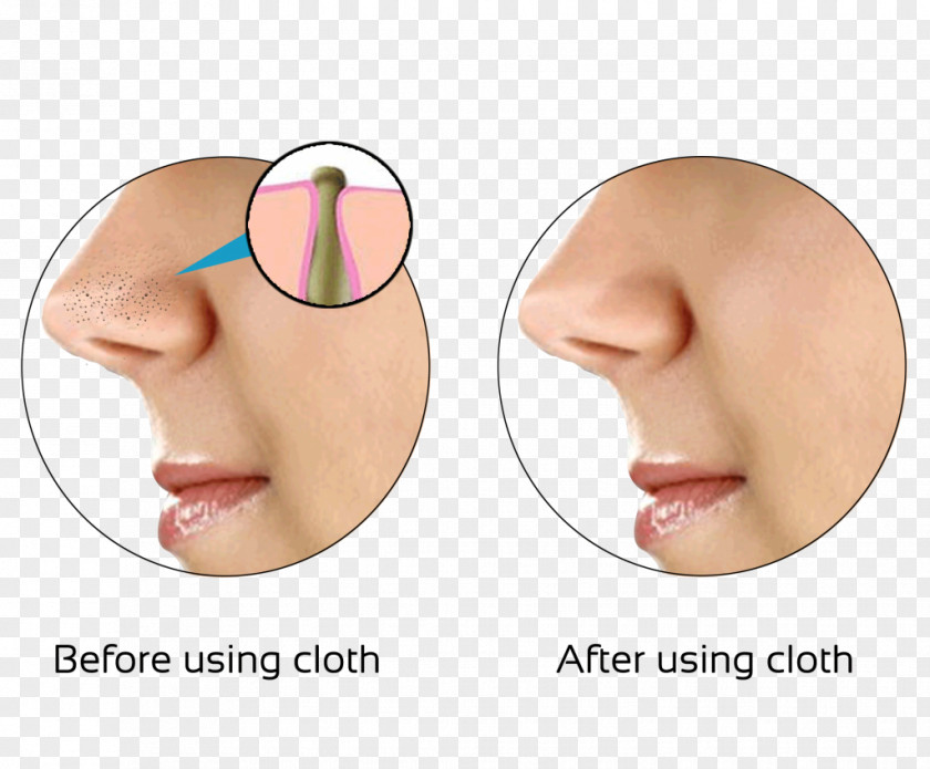 Nose Comedo Skin Exfoliation Pimple PNG
