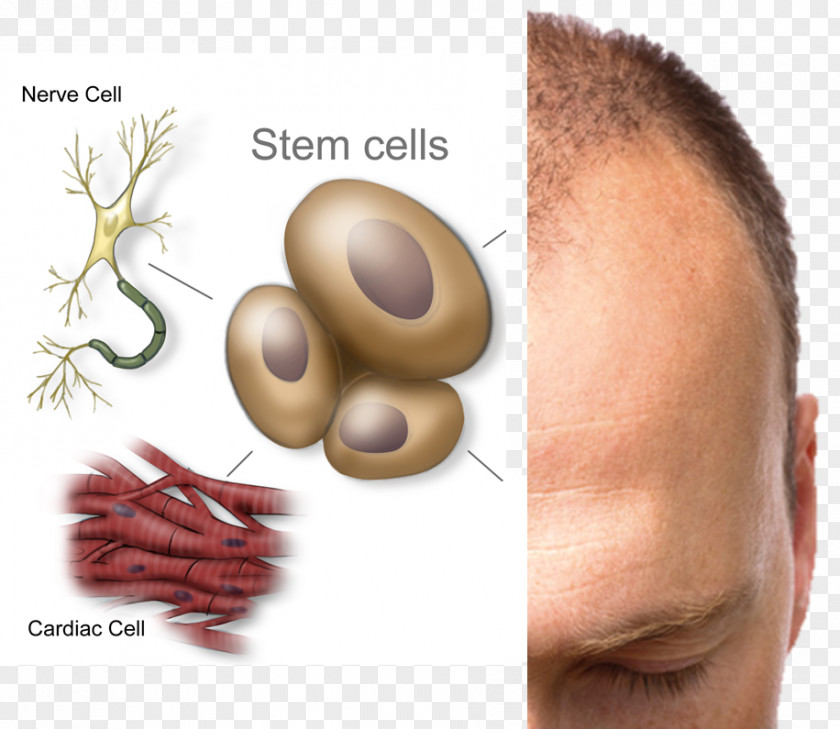 Hair Loss Stem Cell Stem-cell Therapy Disease Cord Blood Bank PNG