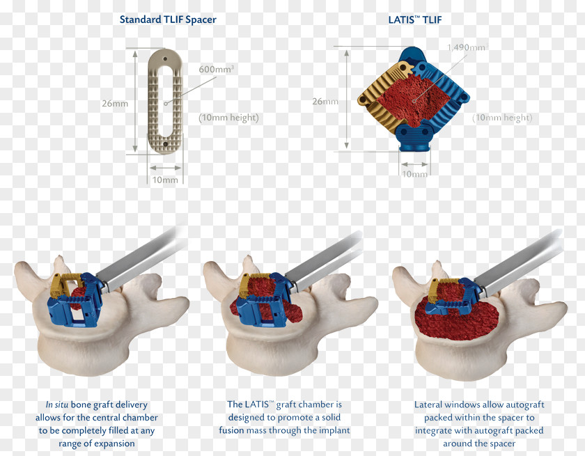 Implant Tooth Technology PNG