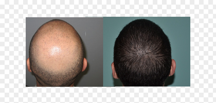 Hair Transplantation Follicular Unit Extraction Loss Organ PNG transplantation unit extraction loss transplantation, transplant clipart PNG