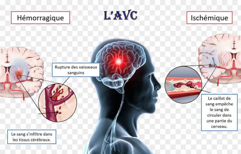 Cerveau Stroke Transient Ischemic Attack Ischemia Stanley L. Goodman M.D. Disease PNG