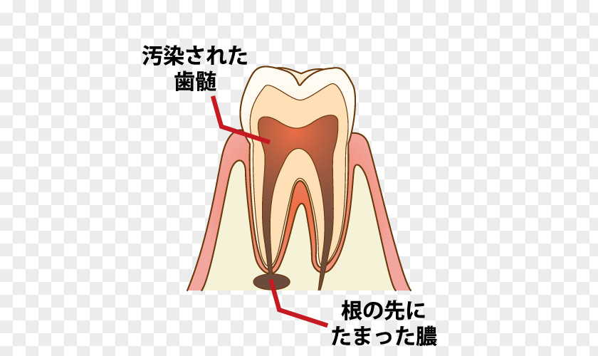 Captions Dentist 歯科 Root Canal Tooth Decay Endodontic Therapy PNG