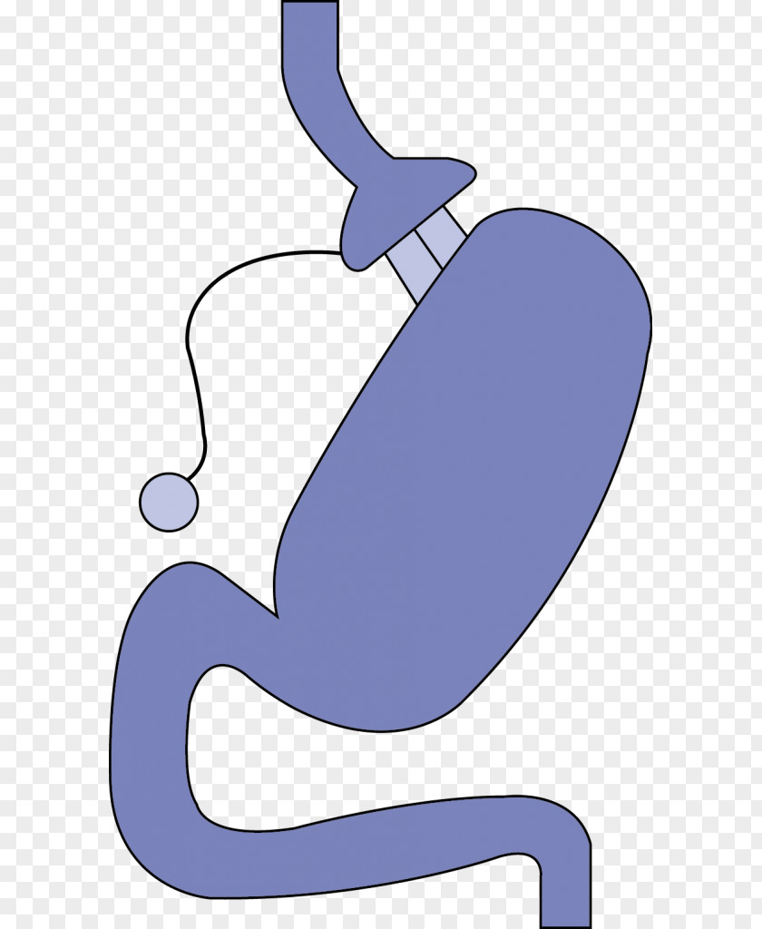 Adjustable Gastric Band Bariatric Surgery Bypass Laparoscopy PNG