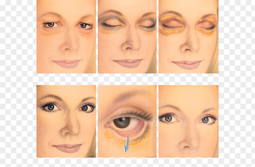 Biomedical Cosmetic Surgery Blepharoplasty Eyelid Periorbital Puffiness PNG