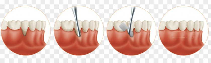 Gingival Graft Gums Soft Tissue Recession PNG