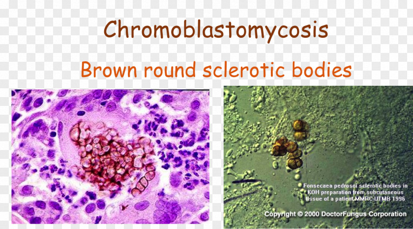 USMLE Step 3 Honey Bee Lavender Phaeohyphomycosis Font PNG