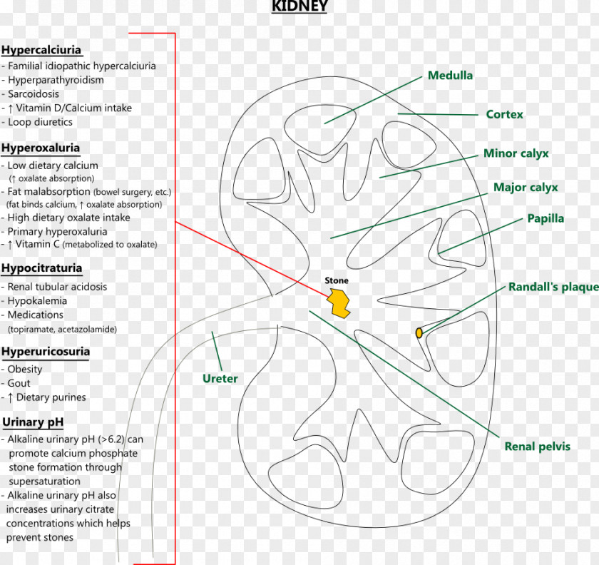 Kidney Uric Acid Stone Urine Joint PNG