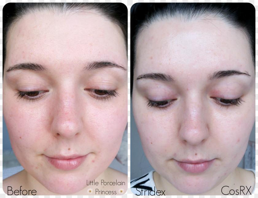 Pimple COSRX One Step Clear Facial Pad Acne Beta Hydroxy Acid Stridex Maximum PNG
