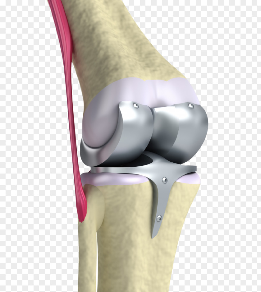 Knee Osteoarthritis Replacement Joint Surgery Prosthesis PNG