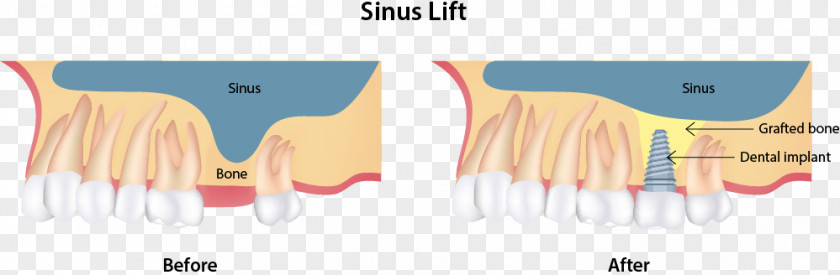 Sinus Lift Dental Implant Dentist Surgery PNG