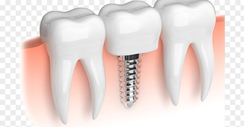 Crown Dental Implant Dentistry Tooth Restoration PNG