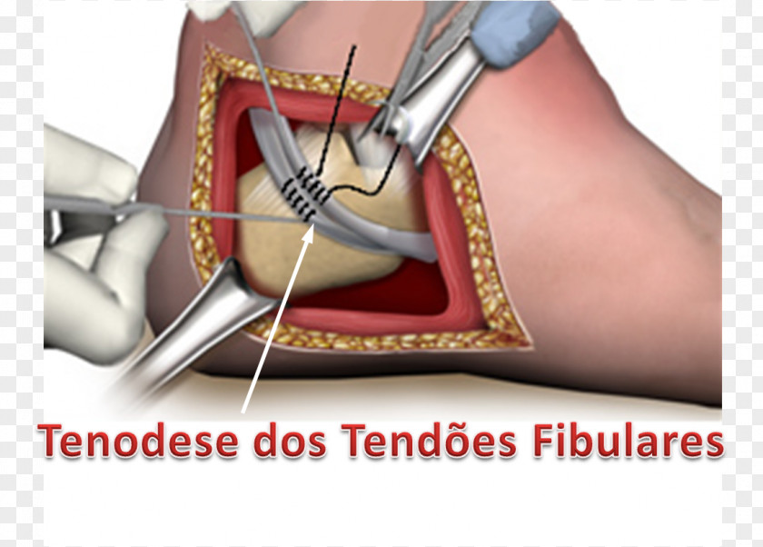 Tubular Tendon Thumb Peroneus Brevis Longus Foot PNG