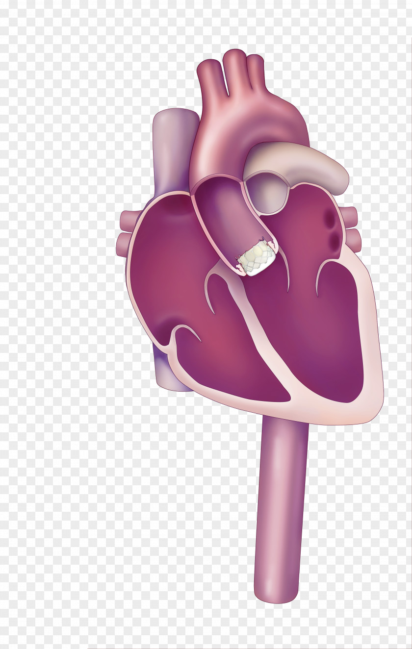 Heart Percutaneous Aortic Valve Replacement Valvular Stenosis PNG
