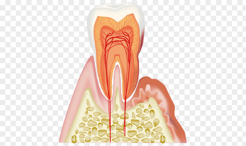 Periodontal Disease Dentistry Gums PNG