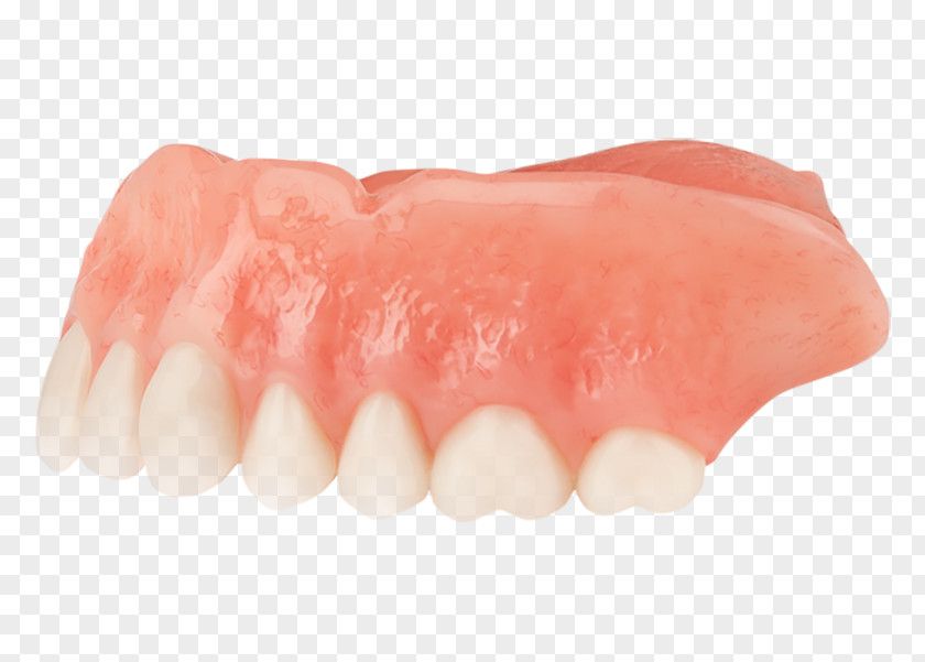 Bridge Dentures Tooth Dentistry Dental Implant PNG