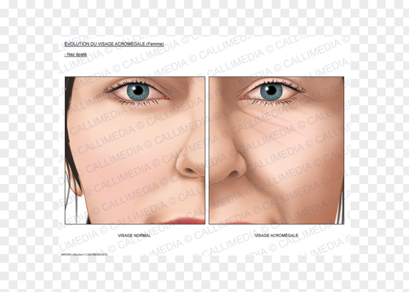 Nose Acromegaly Face Growth Hormone Endocrinology PNG